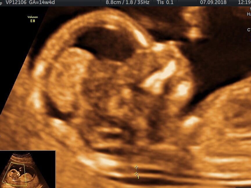 ecografia en bebe con down