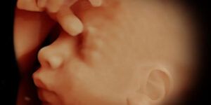 embarazo tras aborto por malformacion