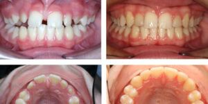 frenillo labial cicatrizacion y consejos