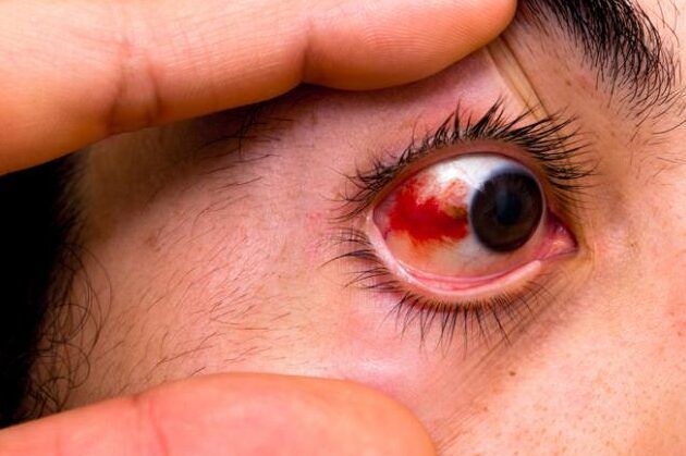 ojos rojos y lagrimas