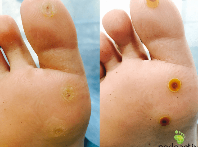 papiloma en el pie informacion y tratamiento