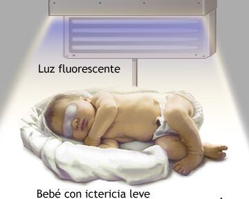 bilirrubina en bebes tratamiento efectivo