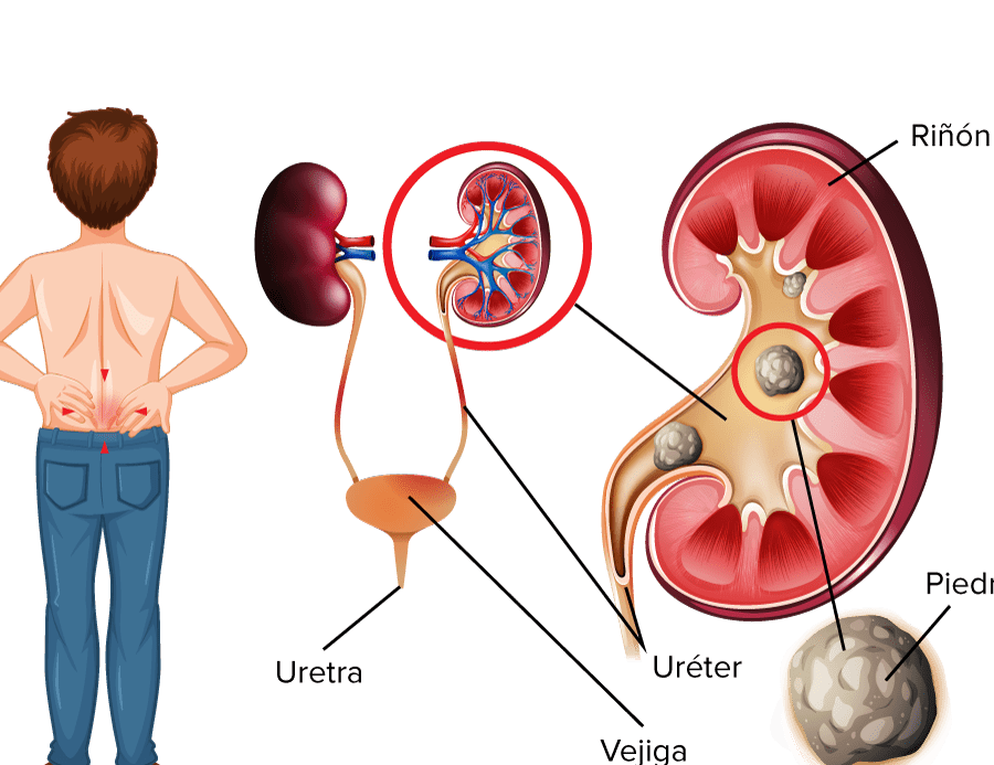 consejos para colico nefritico