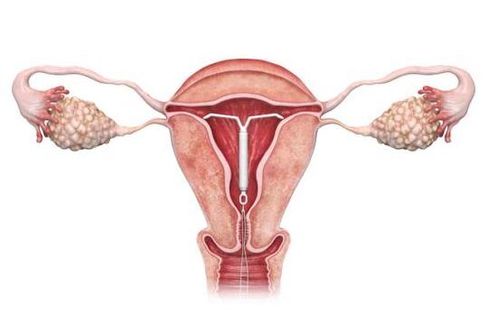 diu caducado eficacia afectada