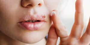 remedio casero para herpes labial