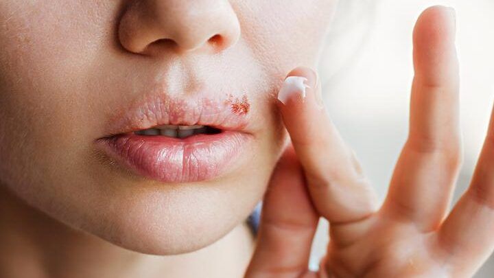 remedio casero para herpes labial