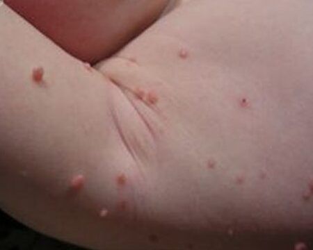 tratamiento natural para moluscos infantiles