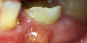 absceso en dientes de leche