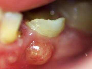 absceso en dientes de leche