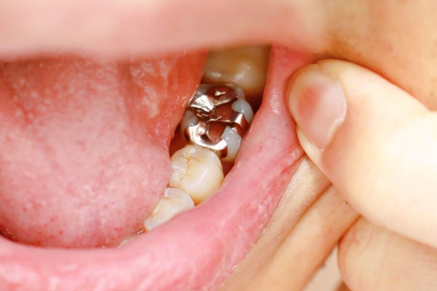 alternativas a empastes de resina