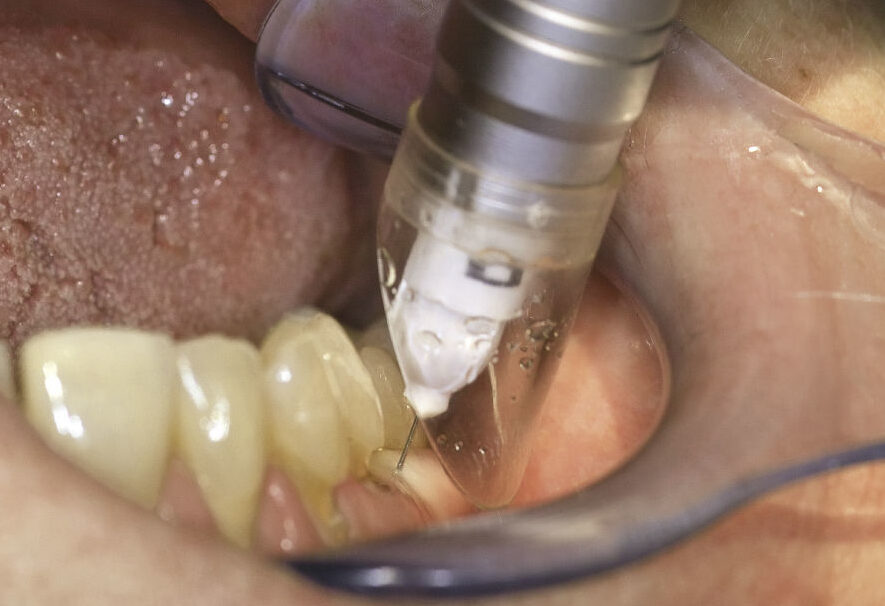 alternativas a la anestesia en odontologia