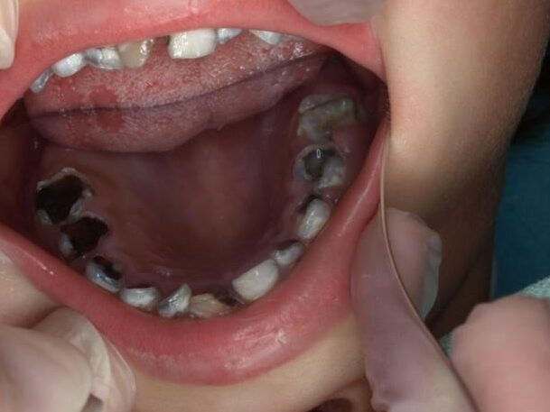 caries en ninos causas y prevencion