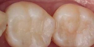 colocacion de empastes en dientes