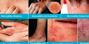complicaciones de la dermatitis atopica
