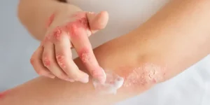 consejos para cuidar piel psoriasica infantil