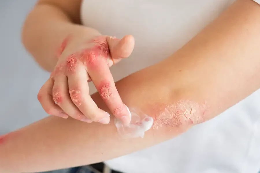consejos para cuidar piel psoriasica infantil