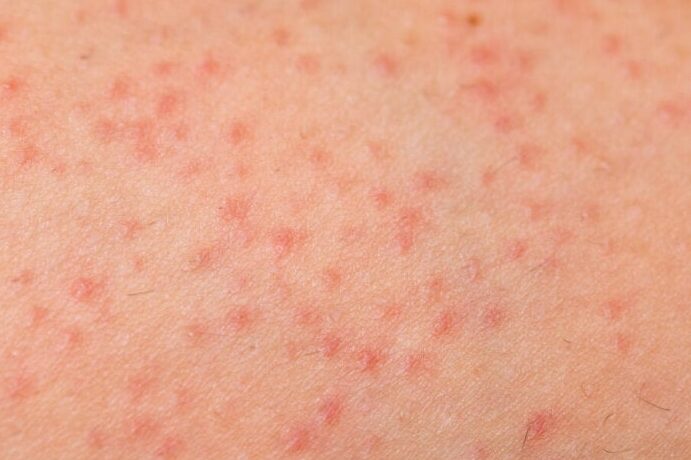consejos para tratar foliculitis en ninos