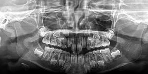 consideraciones para radiografias en ninos