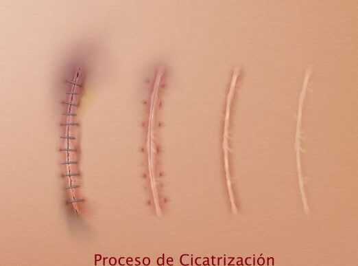 cuidado de cicatrices quirurgicas