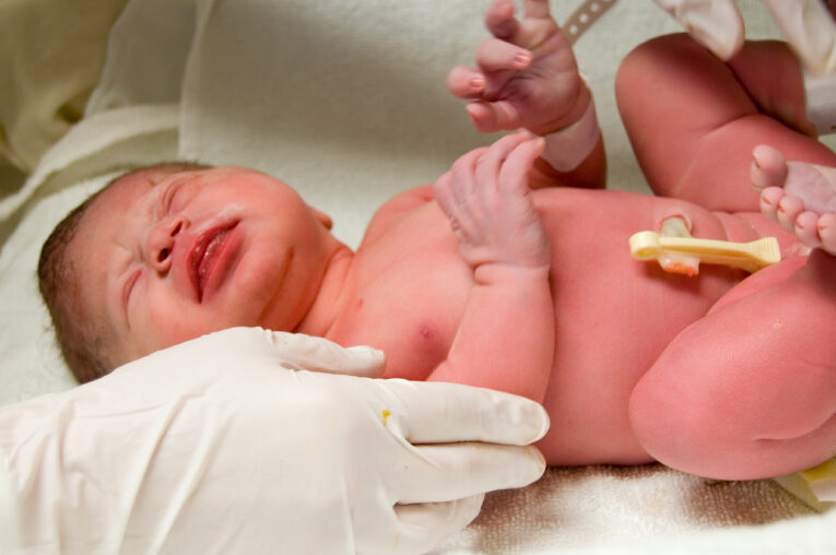 cuidado del cordon umbilical en recien nacidos