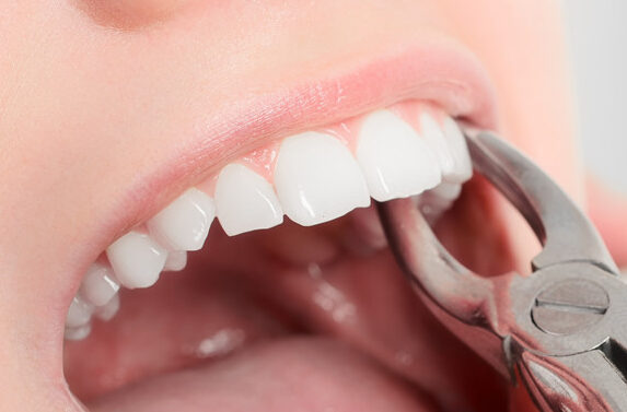 cuidados antes de extraccion dental