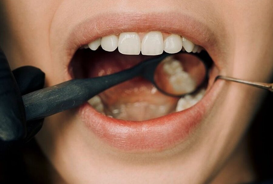 cuidados de cicatrizacion en extraccion dental