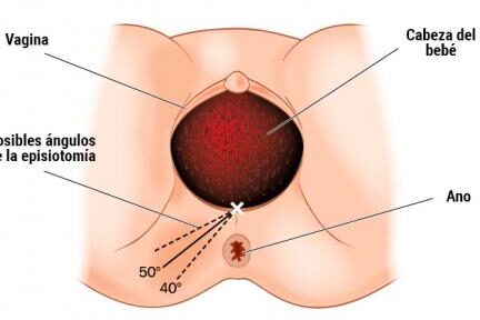 cuidados de la episiotomia posparto