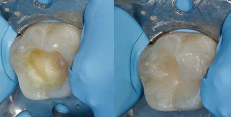 cuidados posteriores a la colocacion de empastes