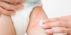 dermatitis del panal en bebes