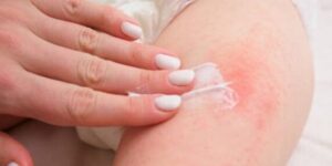 dermatitis del panal prevencion humedad
