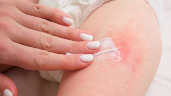 dermatitis del panal prevencion humedad