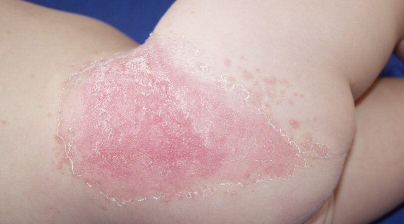 dermatitis del panal sintomas y prevencion