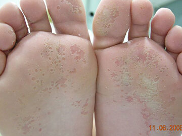 dermatologia infantil y hiperhidrosis