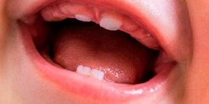 desarrollo de la denticion en bebes