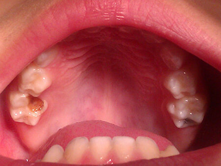diagnostico temprano de caries en ninos