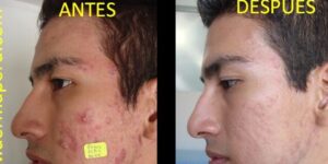 diagnostico y tratamiento del acne