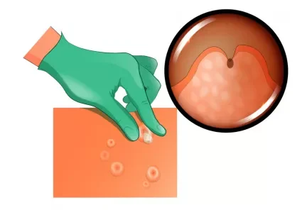 diagnostico y tratamiento del molusco contagioso
