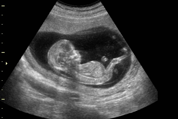 ecografia durante el embarazo