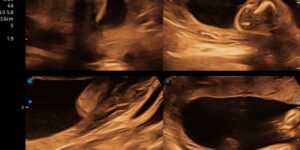 ecografias en el embarazo beneficios y salud del bebe