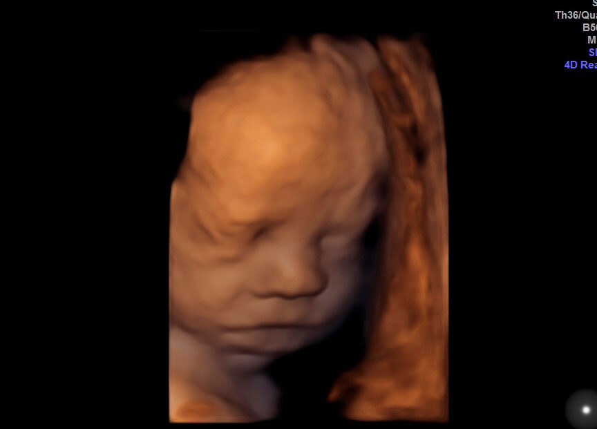 ecografias y control del crecimiento fetal