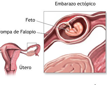embarazo ectopico sintomas causas riesgos