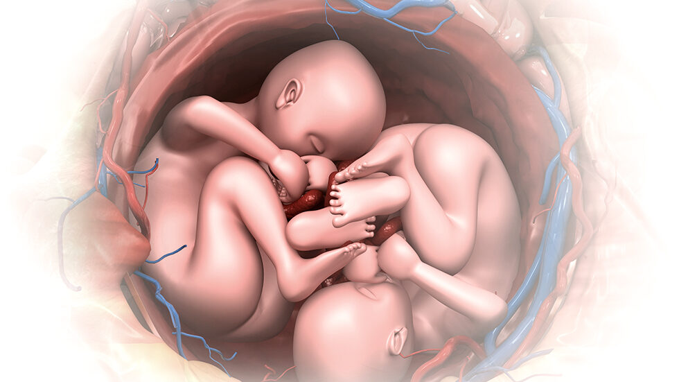 embarazos multiples beneficios y desafios