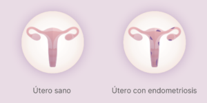 endometriosis y fertilidad informacion clave