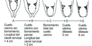etapas y proceso de dilatacion