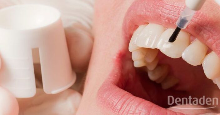 fluorizacion para prevenir la caries