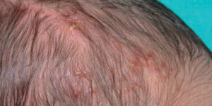foliculitis en la piel infantil