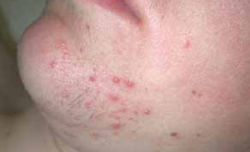 foliculitis y cambios hormonales en la infancia