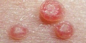 imagen de molusco contagioso
