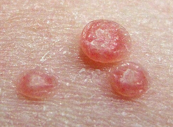 imagen de molusco contagioso
