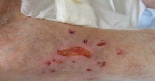 impacto psicologico de alergias cutaneas